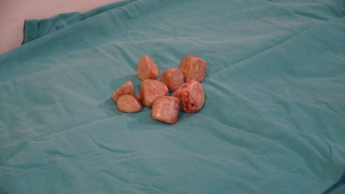 Çanakkale’de, hastanın mesanesinden 20 taş çıkarıldı