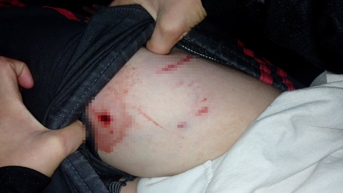 Tekirdağ’da pitbull, 10 yaşındaki çocuğu bacağından ısırdı