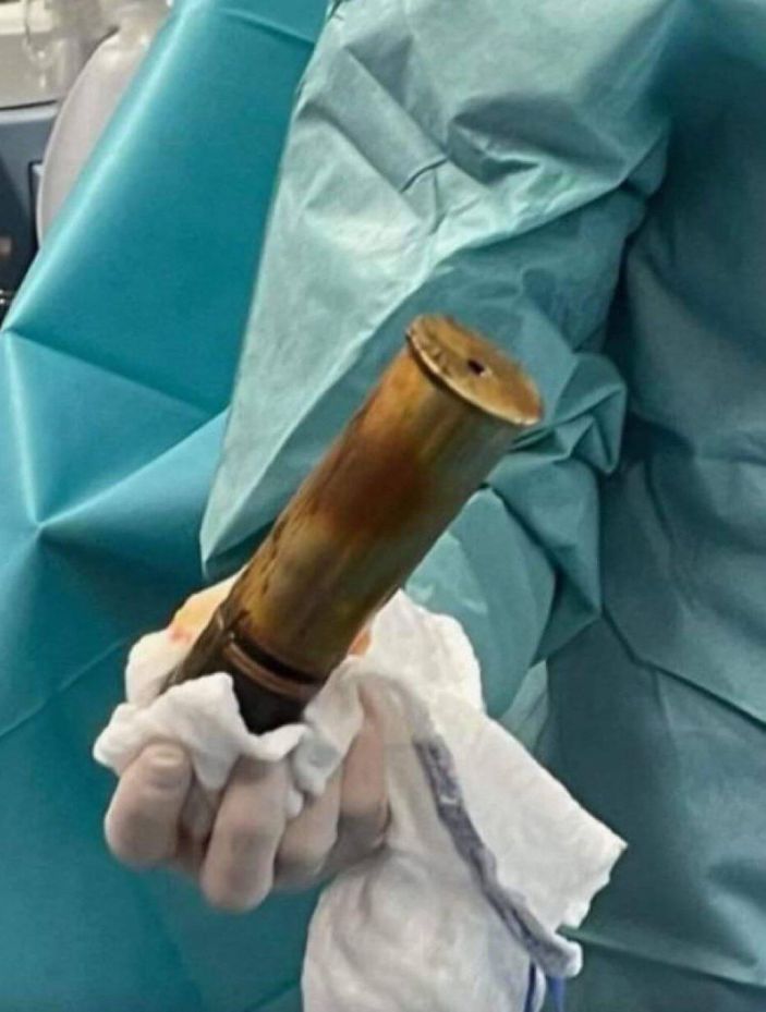 Fransa'da, 88 yaşındaki adamın makatından top mermisi çıkarıldı