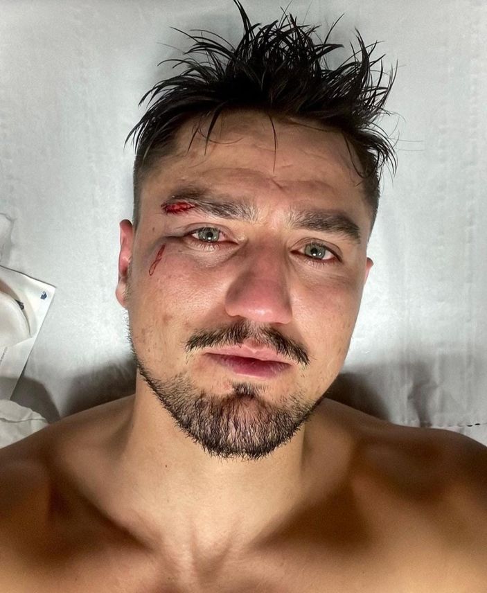 Montpellier maçında kaşı açılan Cengiz Ünder son durumunu paylaştı