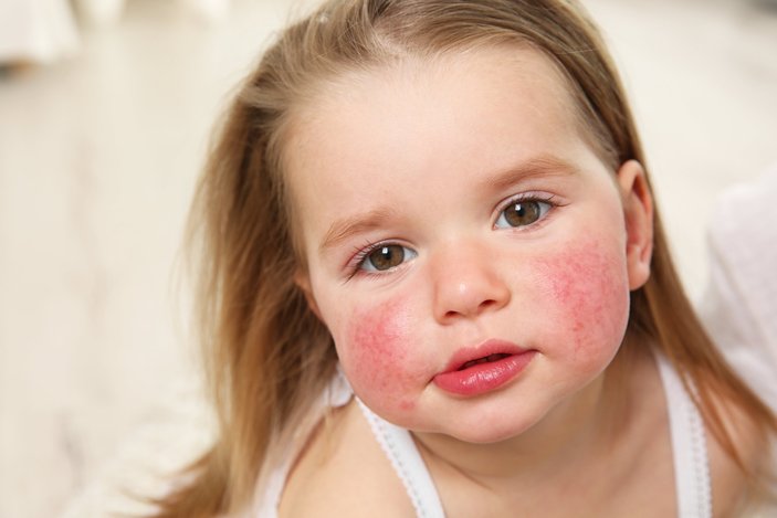 Yetersiz anne sütü alımı alerjiyi tetikleyebiliyor