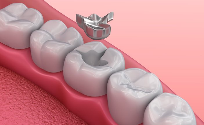 Diş tedavisinde en güvenilir yöntem: Gümüş Dolgu