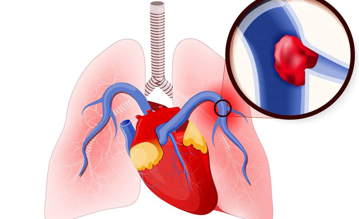 Tüm inmelerin yüzde 20’sini beyin kanamaları oluşturuyor