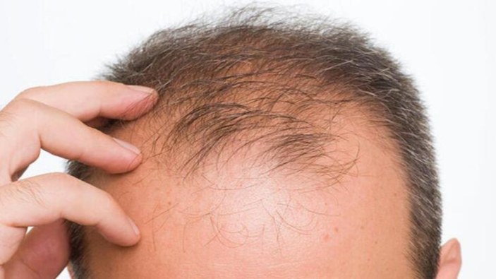 Saç dökülmesini önlemek için 11 doğal çözüm