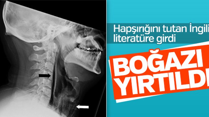 Hapşırırken boğazı yırtıldı