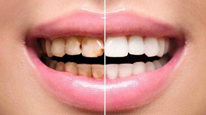 Beyaz dişlerin sırrı bu üç malzemede! Haftada bir kez uygulayın, sarı dişlere veda edin...