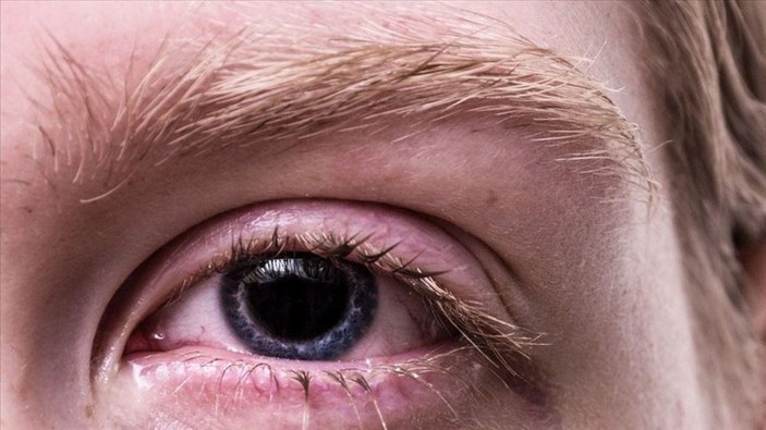 Göz damarı tıkanıklığı koronavirüs belirtisi olabilir