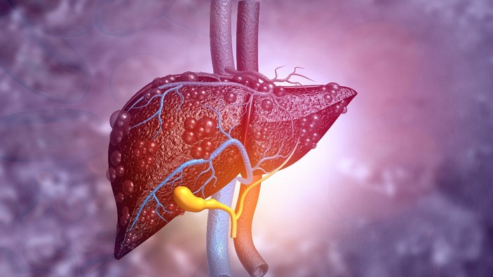 Kansere yol açan sessiz hastalık: Karaciğer yağlanması