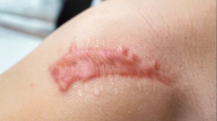 Keloid nedir