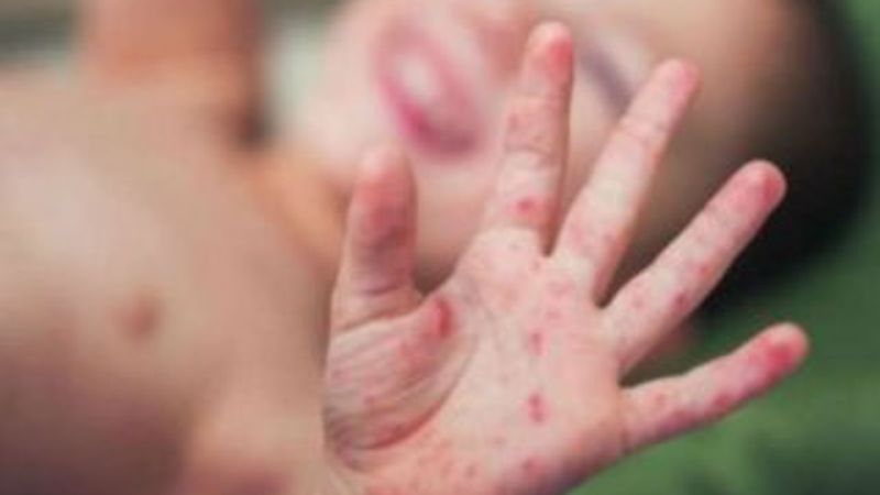 Gürcistan'da kızamık salgını