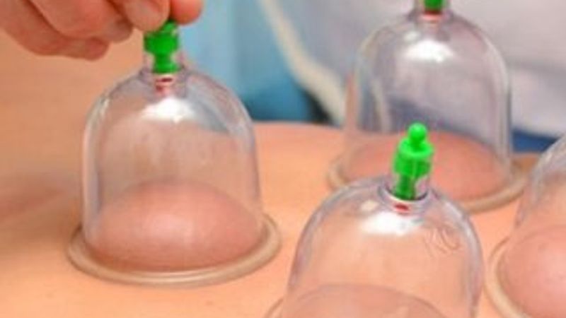 Tabipler Birliği hacamata karşı