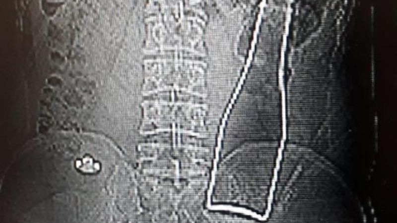Karaman'da karın ağrısıyla hastaneye gitti, şişe çıktı