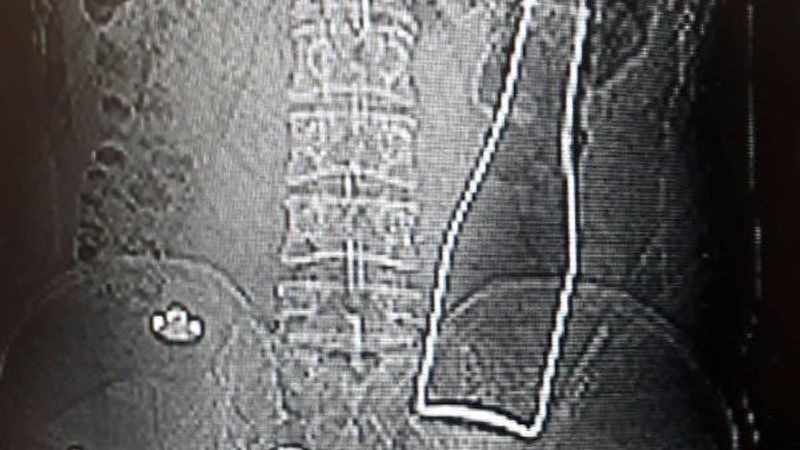 Karaman'da vücudundan şişe çıkan kişi konuştu