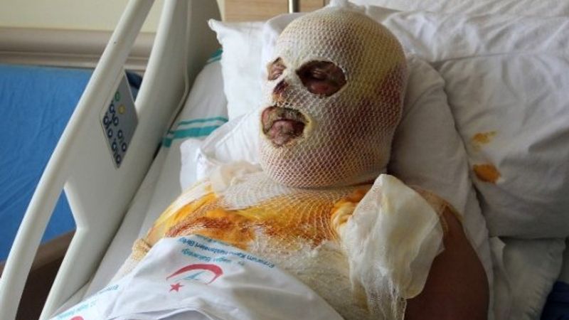 Ardahan'da çay demlemek için sobaya benzin döktü: Yandı