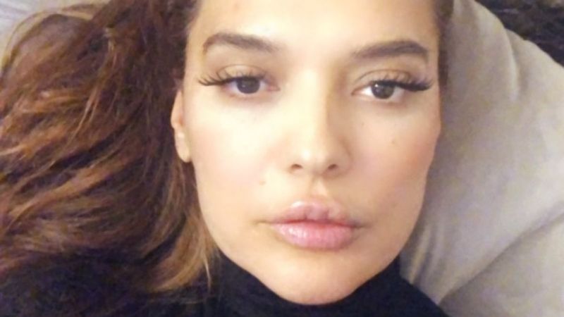 Demet Akalın, dudak dolgusu yaptırdı