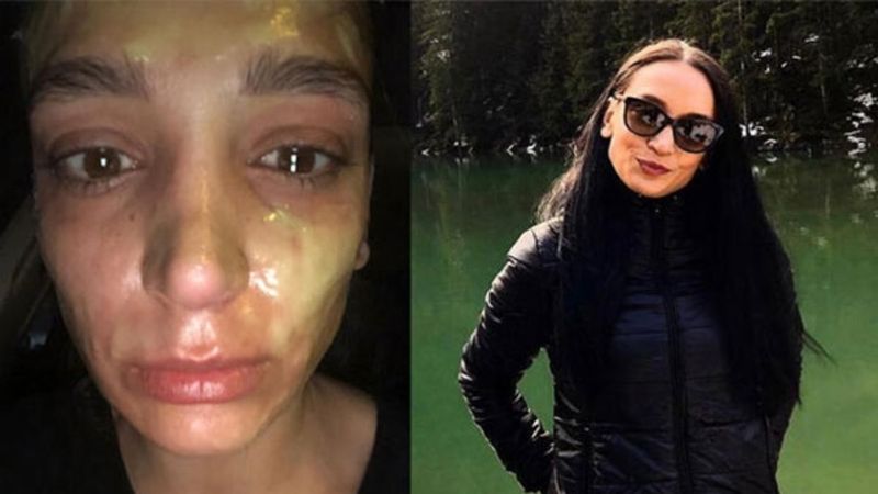 İstanbul'da yüzünde lavabo açıcı patladığını iddia etti: 1,5 milyonluk tazminat davası açtı