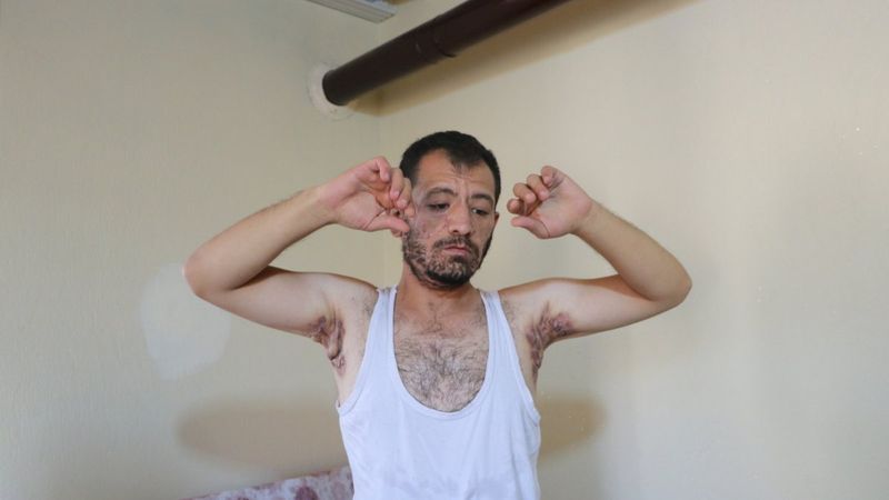 Niğde'de 'Köpek Memesi' hastası Enver Dağtekin: Hastalığım yüzünden eşim bile benden tiksiniyor