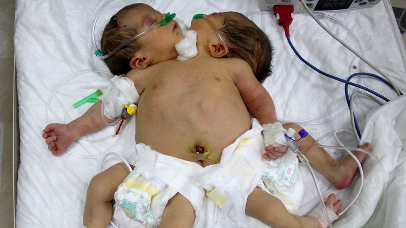 Tek kalple hayata tutunan ‘siyam ikizleri’ tedavi altına alındı