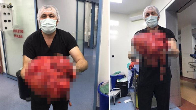 Zonguldak'ta karnından 14 kilogramlık kitle çıkarıldı