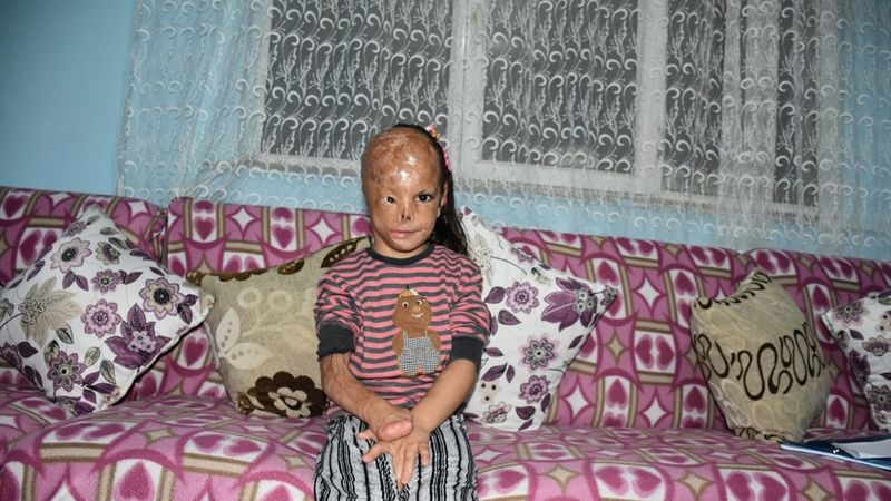 Kocaeli'de bebekken yüzü yanan Dilara yardım bekliyor