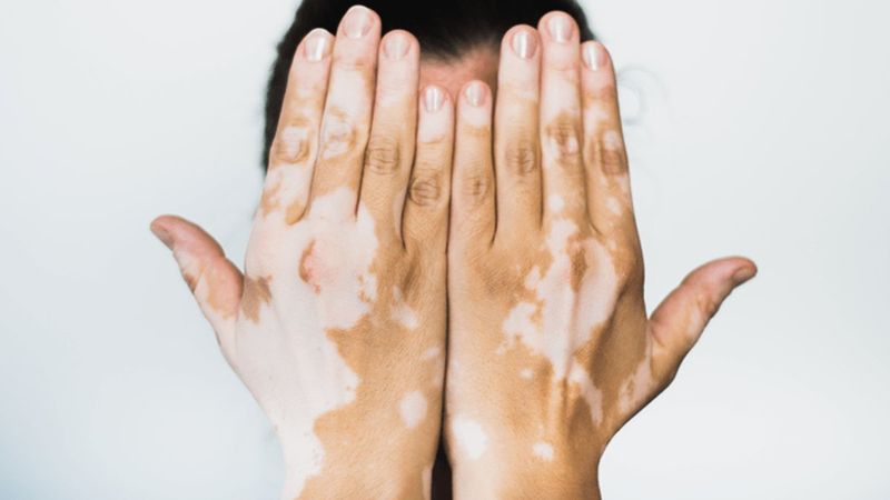 Vitiligo nedir, belirtileri nelerdir? Vitiligo tedavi edilir mi, bulaşıcı mıdır?