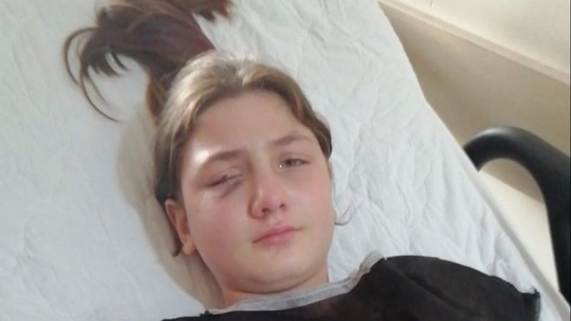 Aydın'da, yastık savaşı yaparken kırılan avize gözünü parçaladı