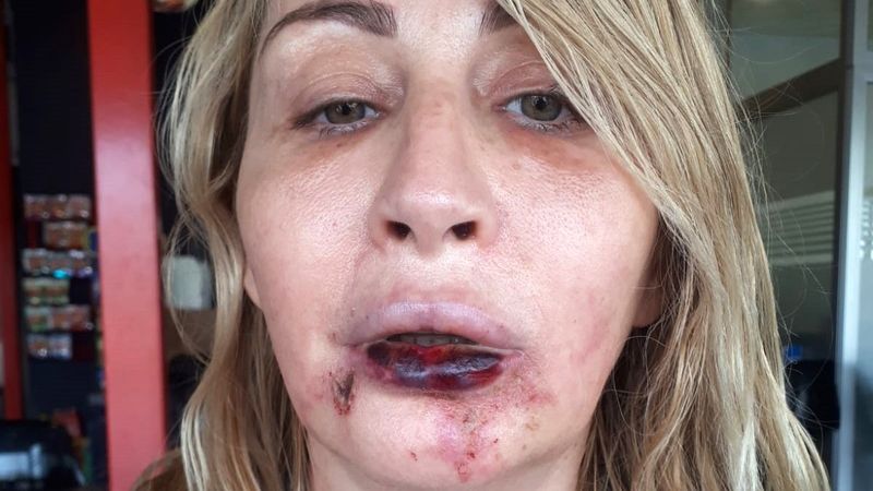 Antalya'da estetik sonrası kaybettiği dudağına yeniden kavuşuyor