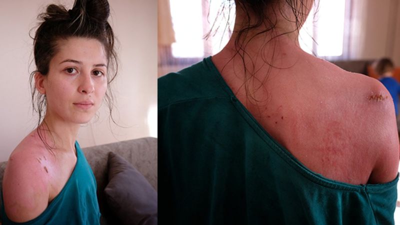 Konya'da eşinin kaynar suyla yaktığı kadın: Kızım beni hatırlamıyor