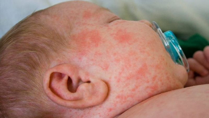 Altıncı hastalık nedir? Altıncı hastalık belirtileri nelerdir? Altıncı hastalığın tedavisi var mı?