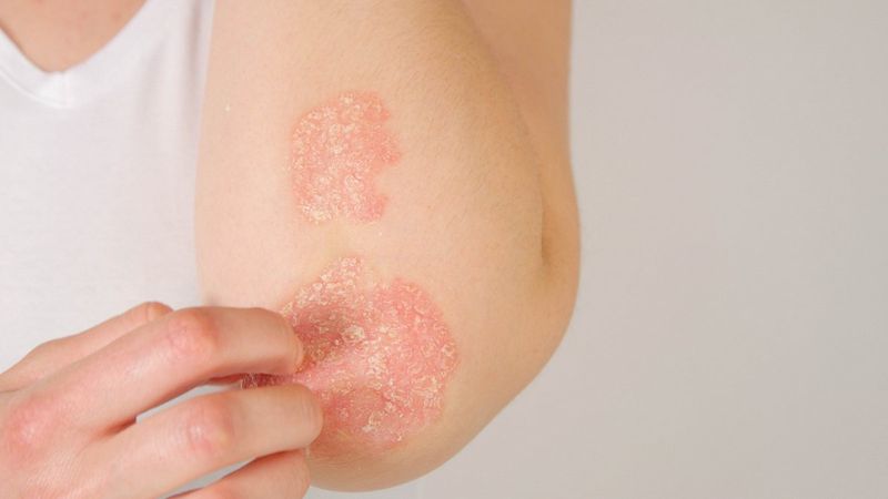 Uzmanından sedef romatizması uyarısı