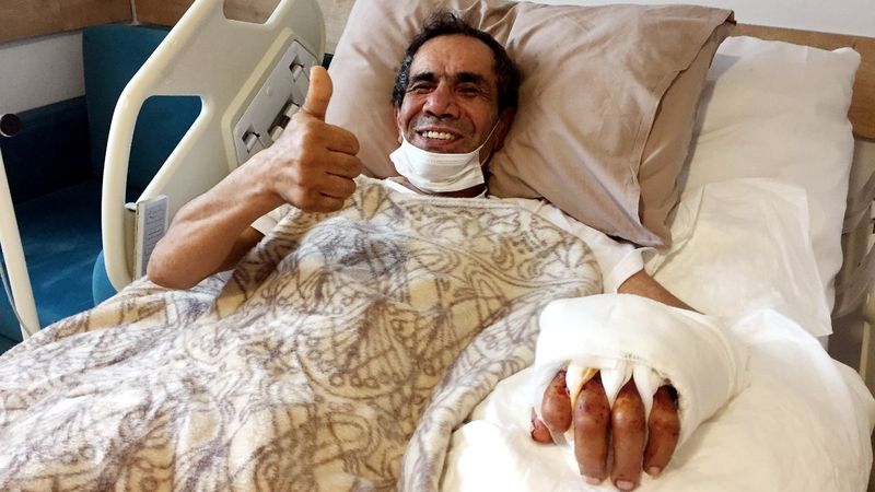 Antalya'da ağaç keserken kopan eli, 10 saatte yerine dikildi