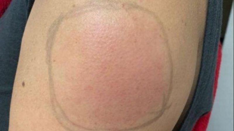 Covid-19 kolu nedir, belirtileri nelerdir? Hangi aşı Covid-19 koluna neden olur?