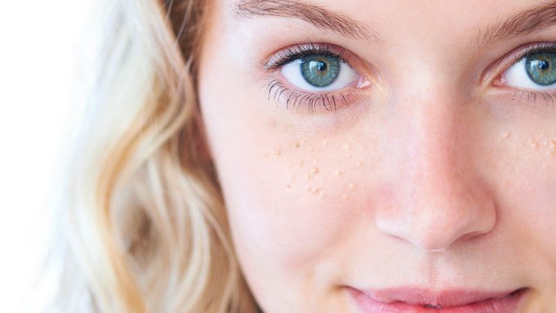 Cildinizde oluşan beyaz yağ bezelerinden kurtulmanın yolları