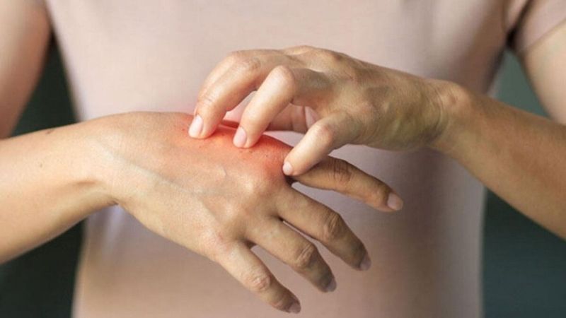 Salgın döneminde temas egzaması arttı