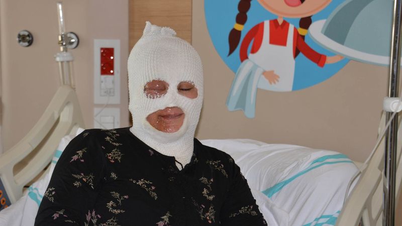 Bayburt'ta demlediği çayı üzerine dökünce yandı