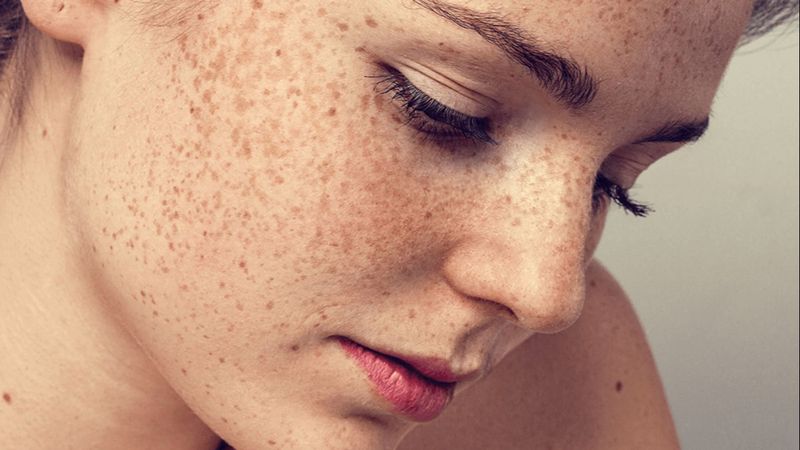 Ciltte renk değişikliğinin nedenleri ve tedavi yöntemleri