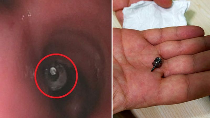 Bursa'da dişçiye giden kadın implant parçasını yuttu