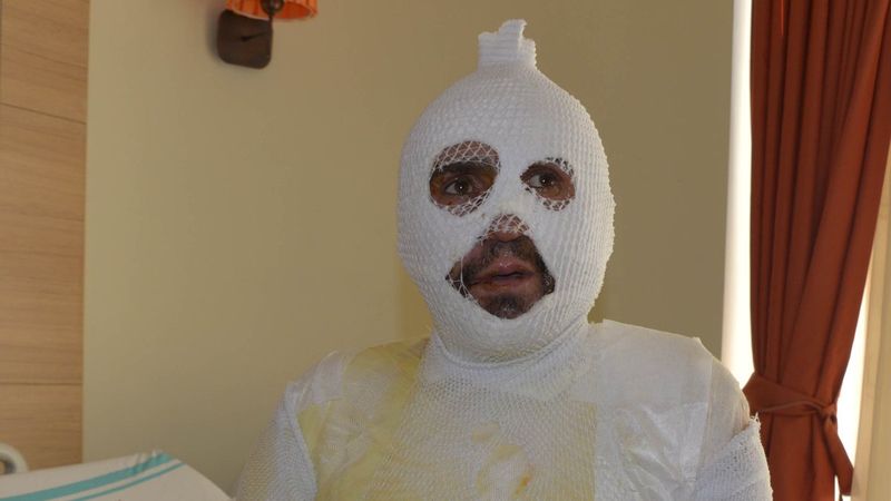 Iğdır'da taciz iddiası sonrası sobadan devrilen su ile yandı