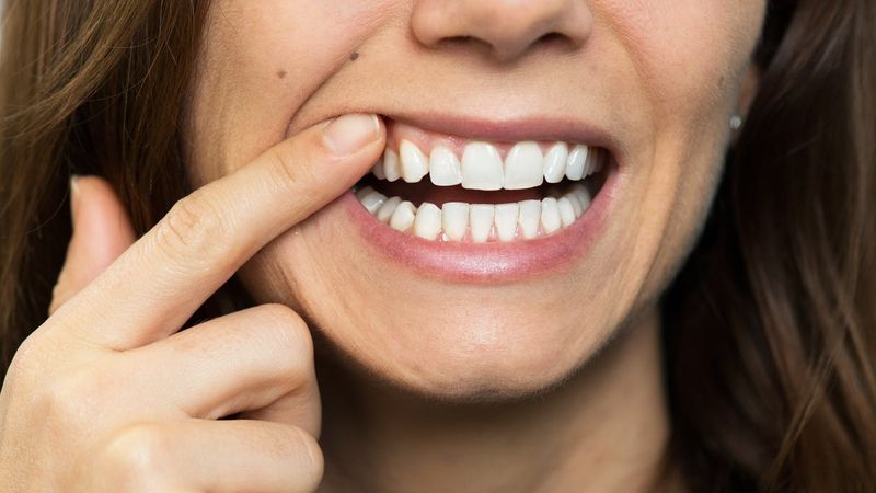 Diş eti hastalığı koronavirüs ölüm riskini 9 kat artırıyor