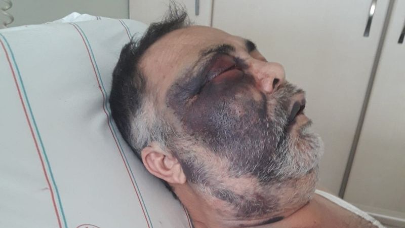 Antalya'da yüzde 90 engelli adamı öldüresiye darbettiler