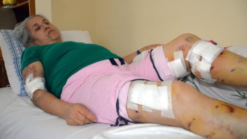 Mersin'de sokak köpeklerinin saldırısına uğrayan kadın