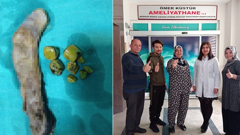 Antalya'da 30 santimlik safra kesesi dünya tıp literatürüne girdi