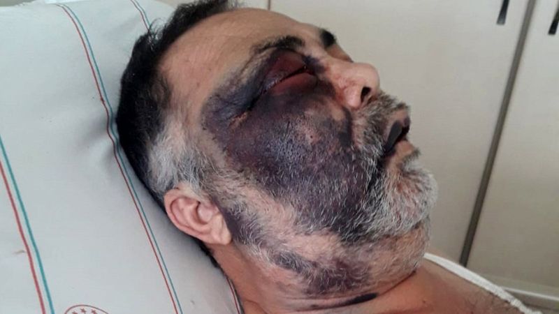 Antalya'da darbedilen yüzde 90 engelli yaşamını yitirdi