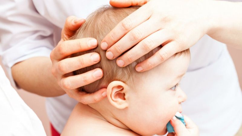 Bebeklerde kafatasının erken kapanması: Kraniosinostoz