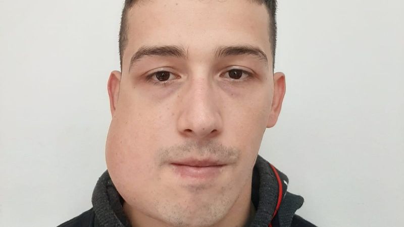 İstanbul’da üniversite öğrencisi çenesindeki tümörden ameliyatla kurtuldu