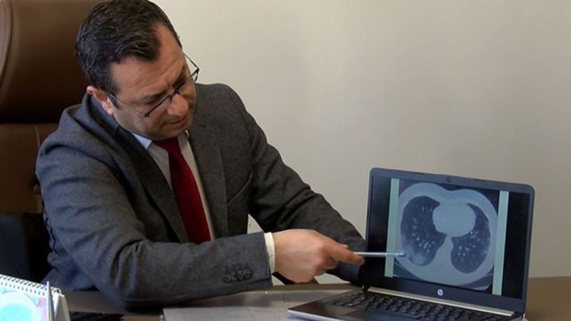 Koronavirüs hastalarında yüzde 30 oranında baş ağrısı tespit edildi