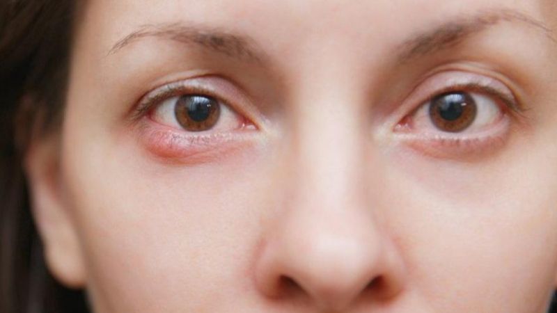 Göz uçuğu görme kaybına neden olabilir