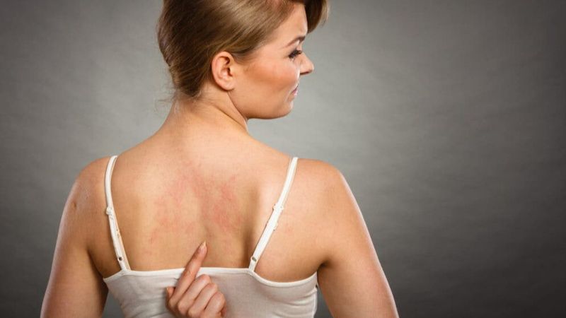 Kurdeşen bulaşıcı bir hastalık değil