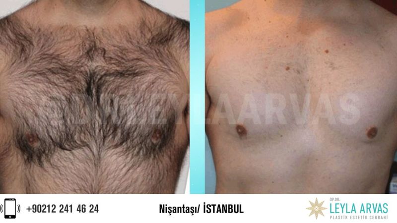 İşte erkeklere özel buz lazer epilasyon için eksiksiz kılavuzumuz