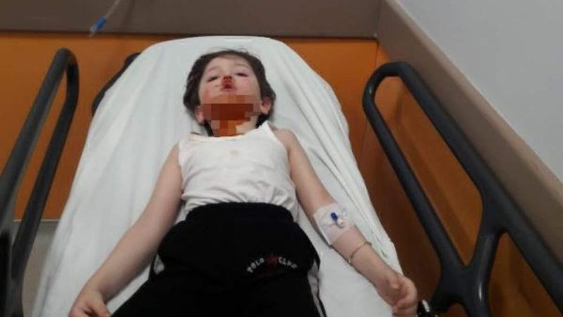 Kocaeli'de 5 yaşındaki çocuğa sokak köpekleri saldırdı